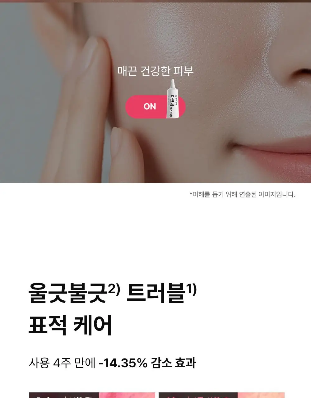 (하루특가)[단독기획] 동아제약 아크네 프로 크림제 30ml 기획(+3ml+겔제3ml) 상세페이지 11